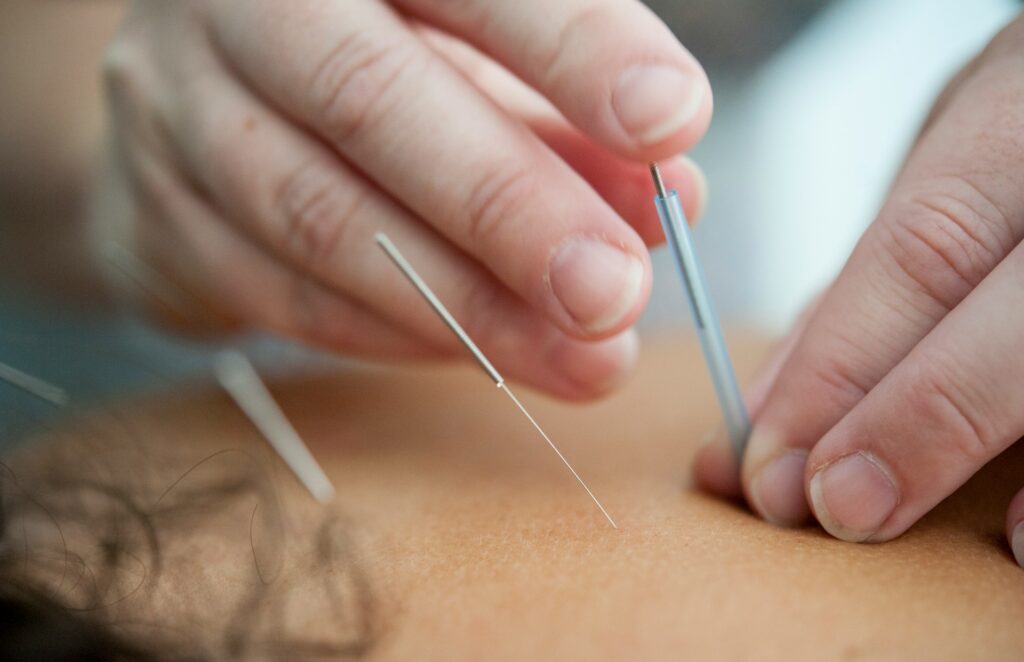 Acupuncture treatment for muscle tension and Qi flow